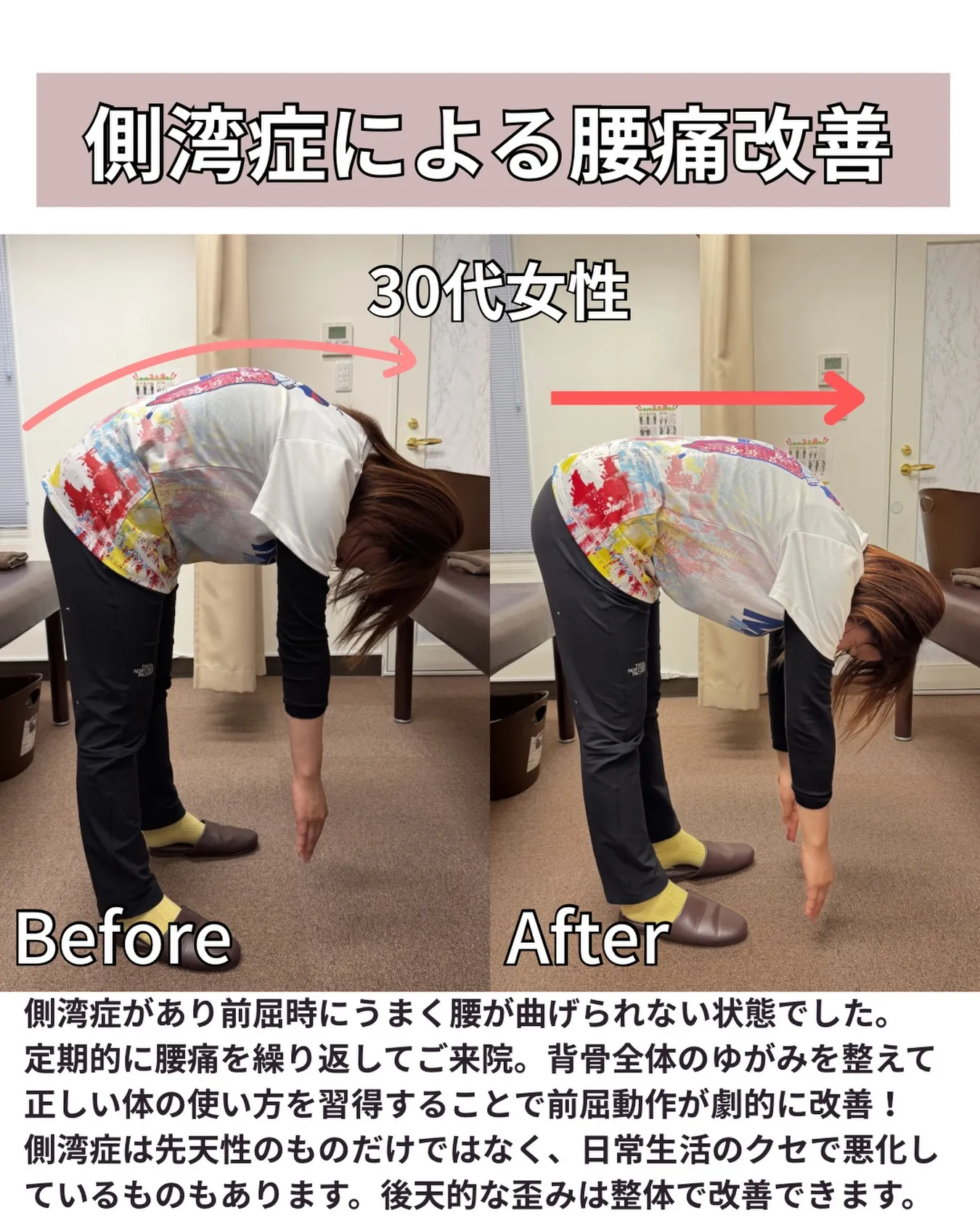 【川西市/側湾症改善/30代女性】