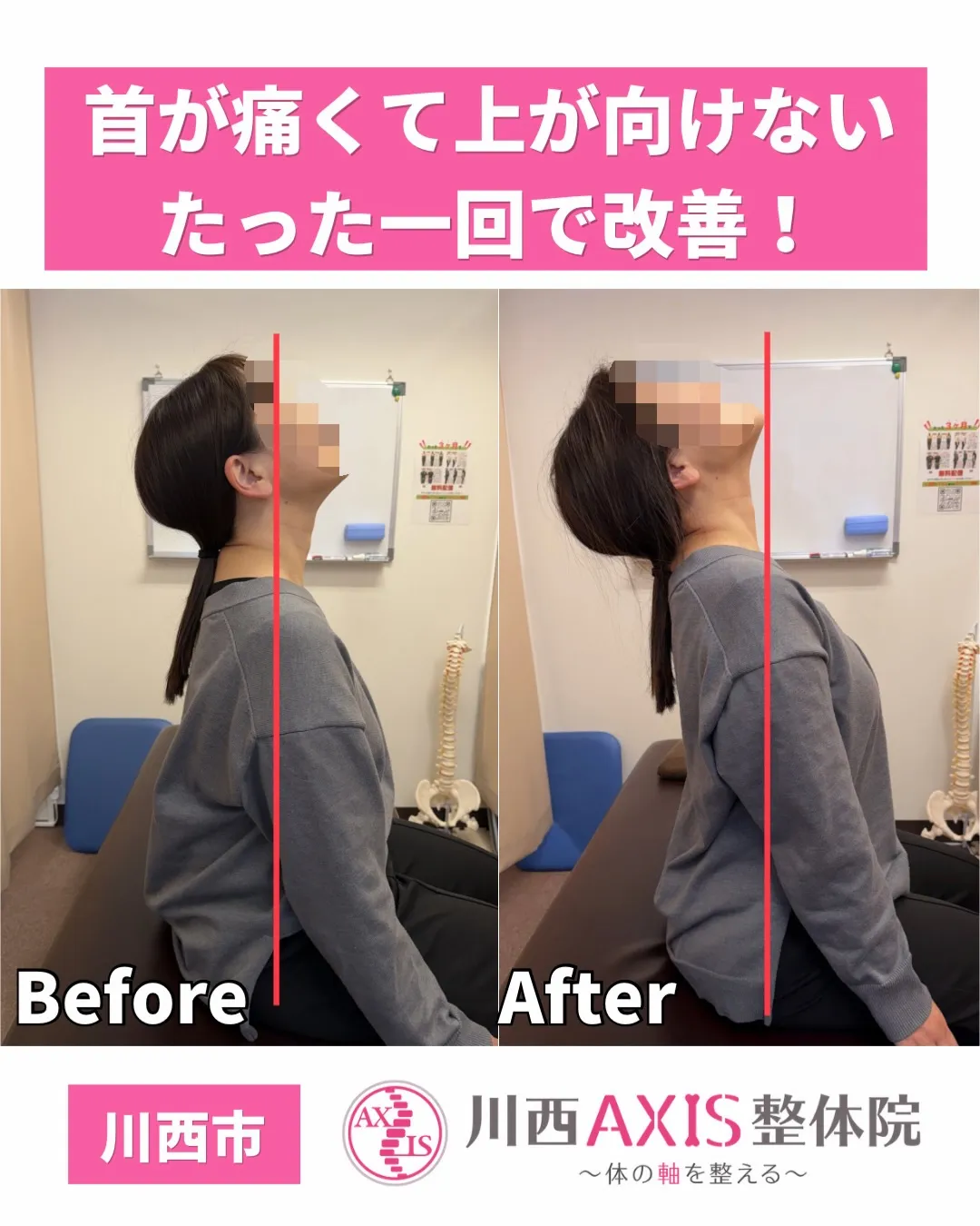 【川西市 首痛 肩こり】