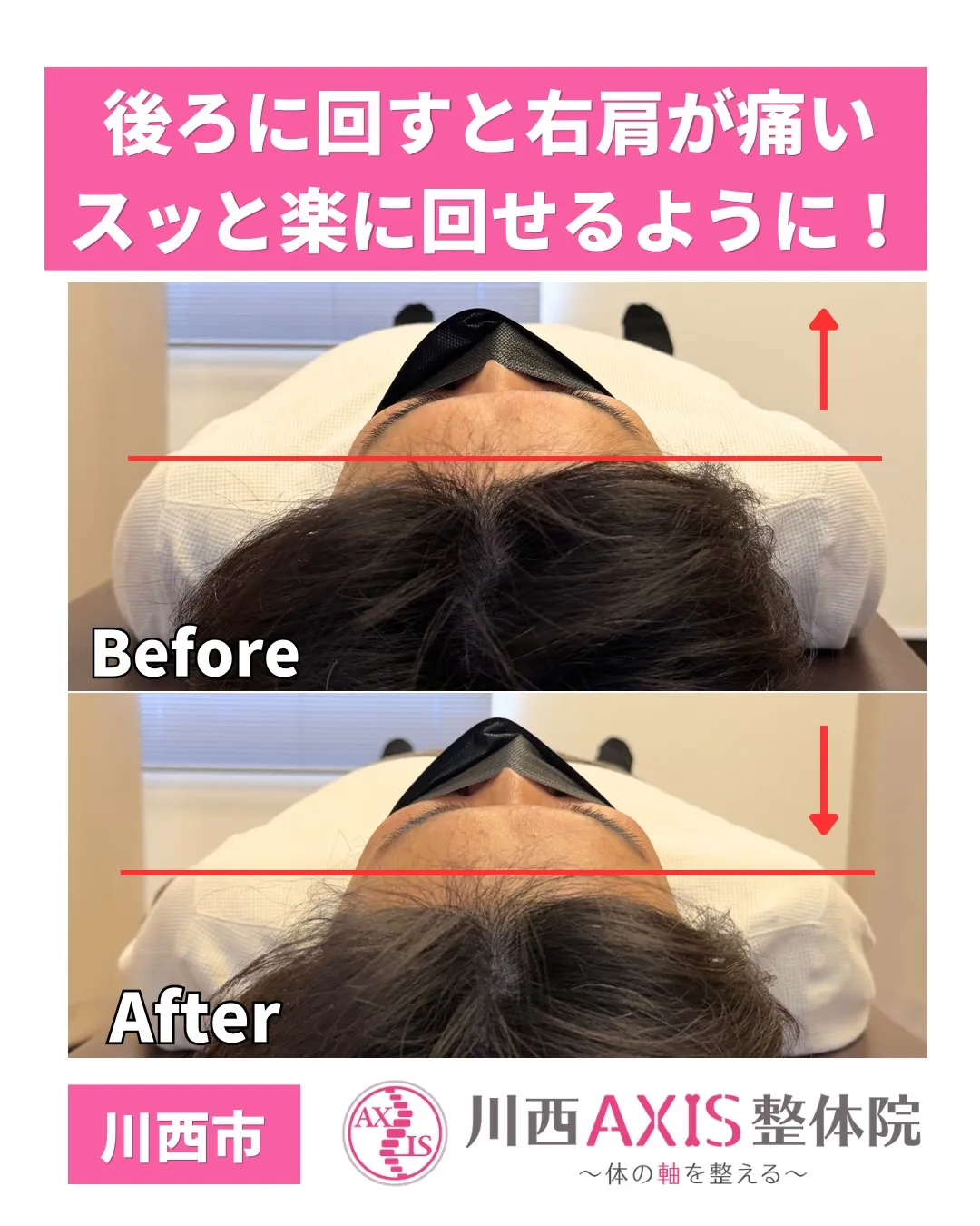 【川西市 肩の痛み】