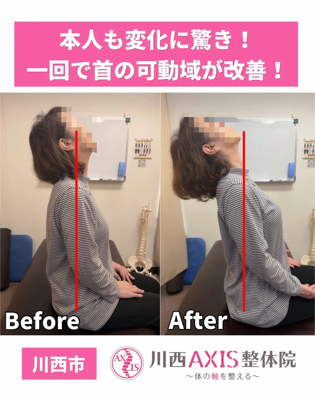 川西市で首の痛みでお悩みなら川西AXIS整体院へ