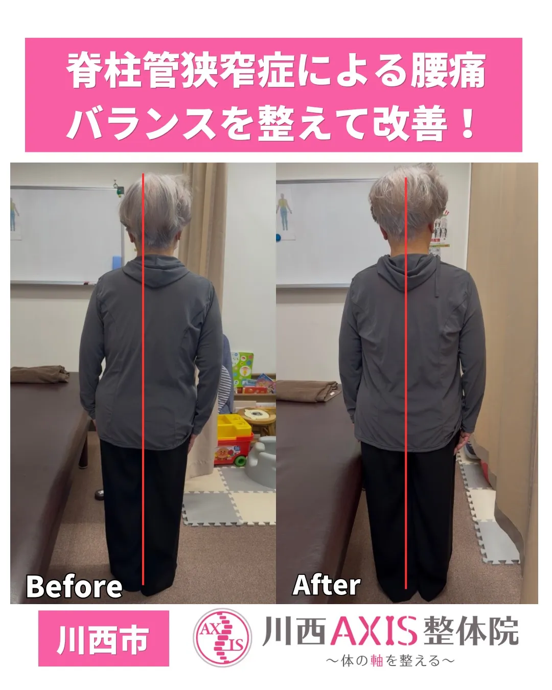 【80代女性／脊柱管狭窄症による腰痛】川西市整体