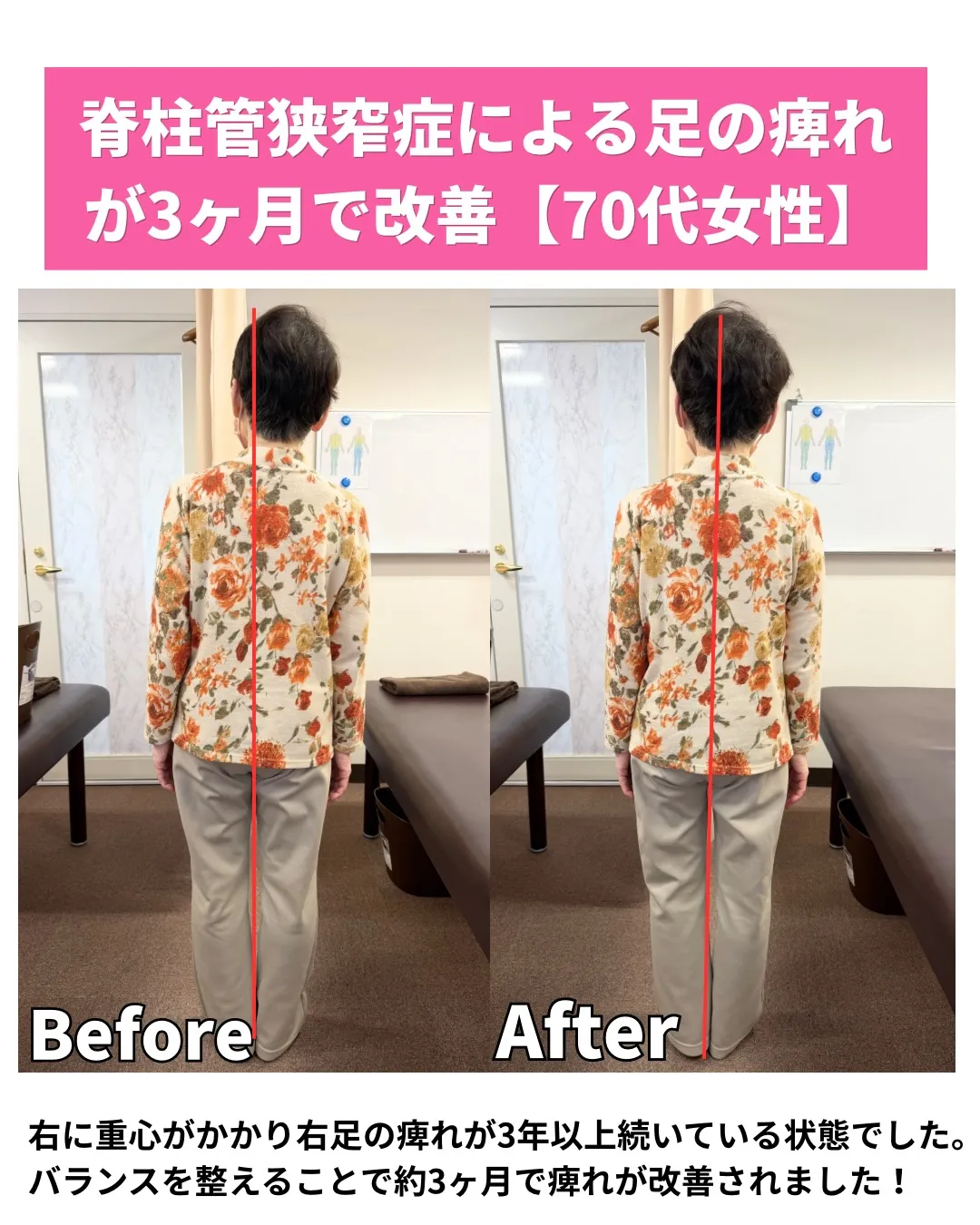 【脊柱管狭窄症による足の痺れ】川西市整体