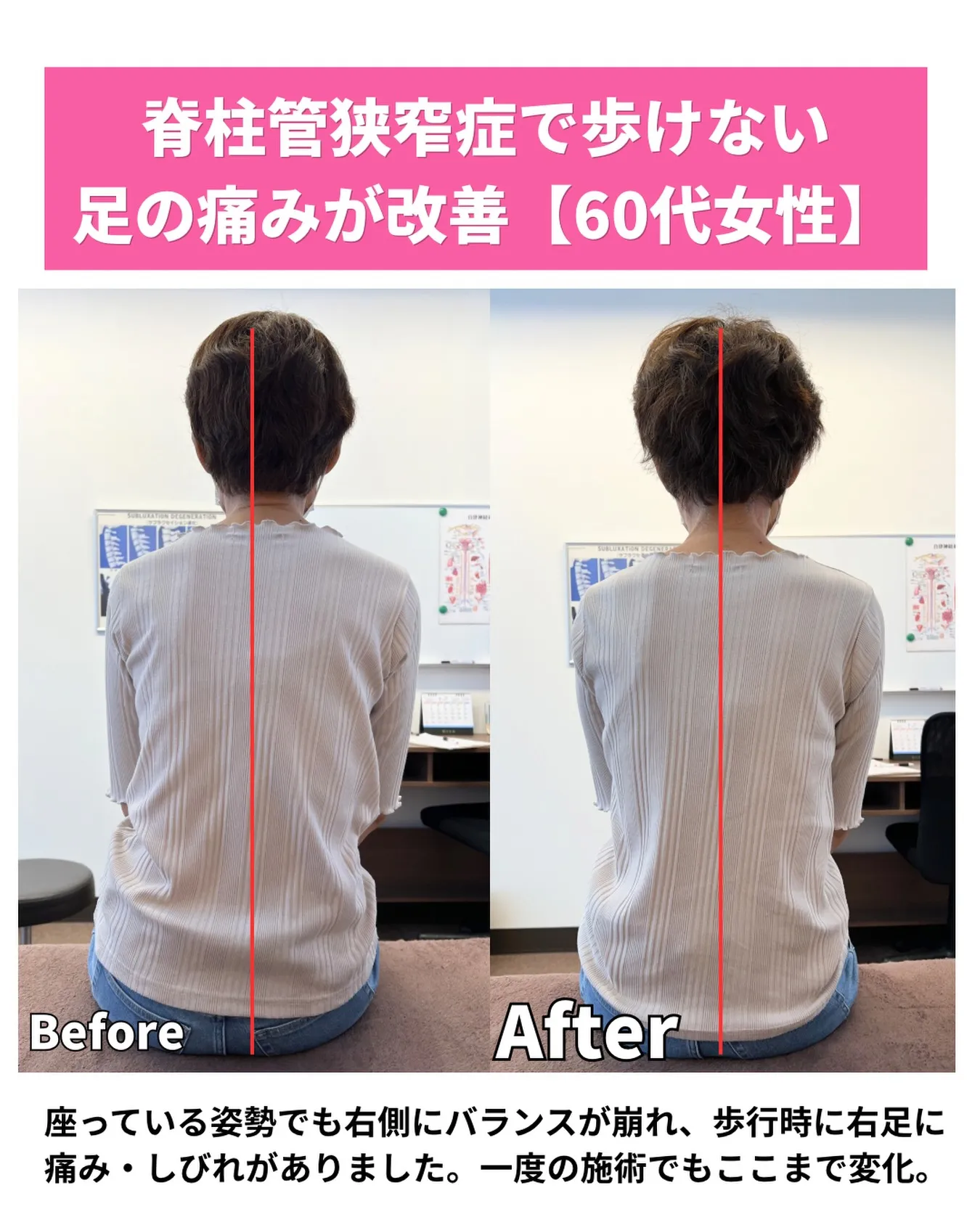 【症例紹介】60代女性　左足の痛みと痺れで来院