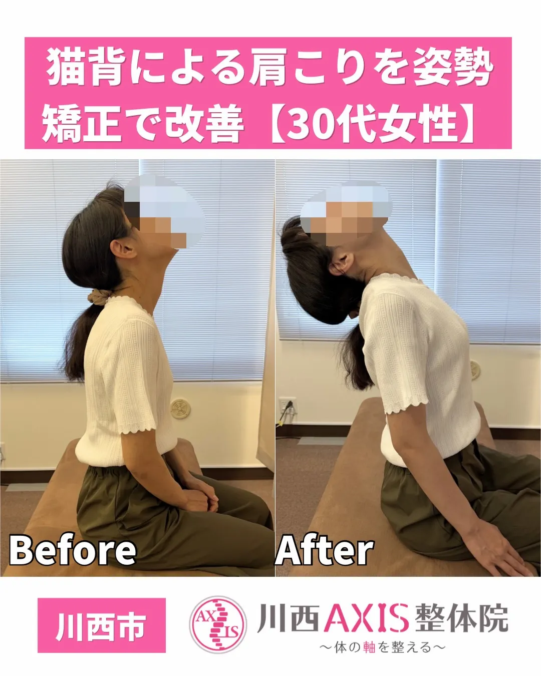 【猫背による肩こりを姿勢矯正で改善✨】