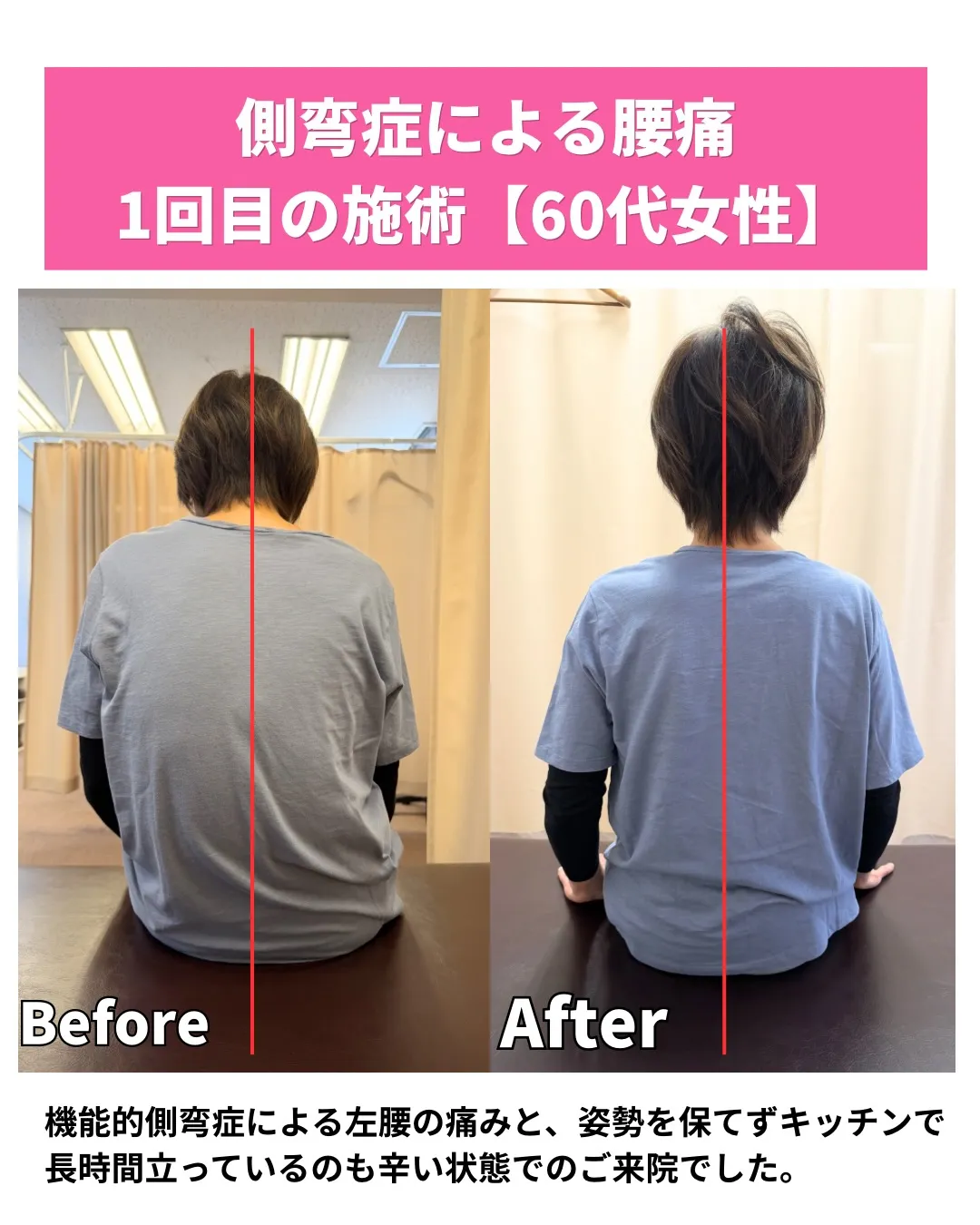 【側湾症による腰痛】川西市整体