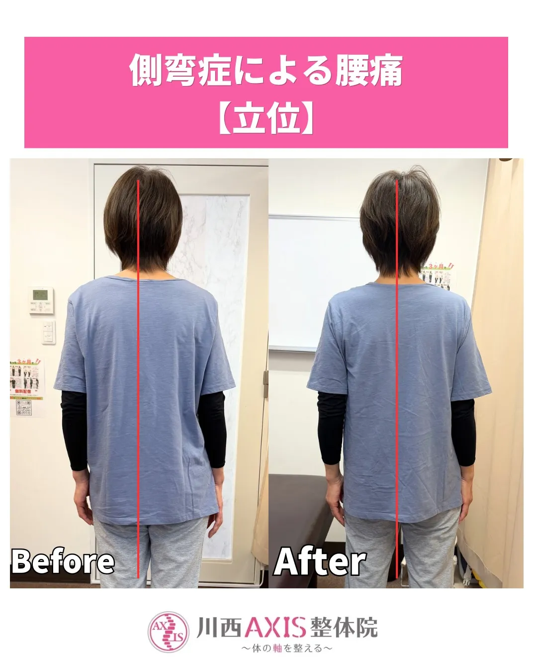 【側湾症による腰痛】川西市整体