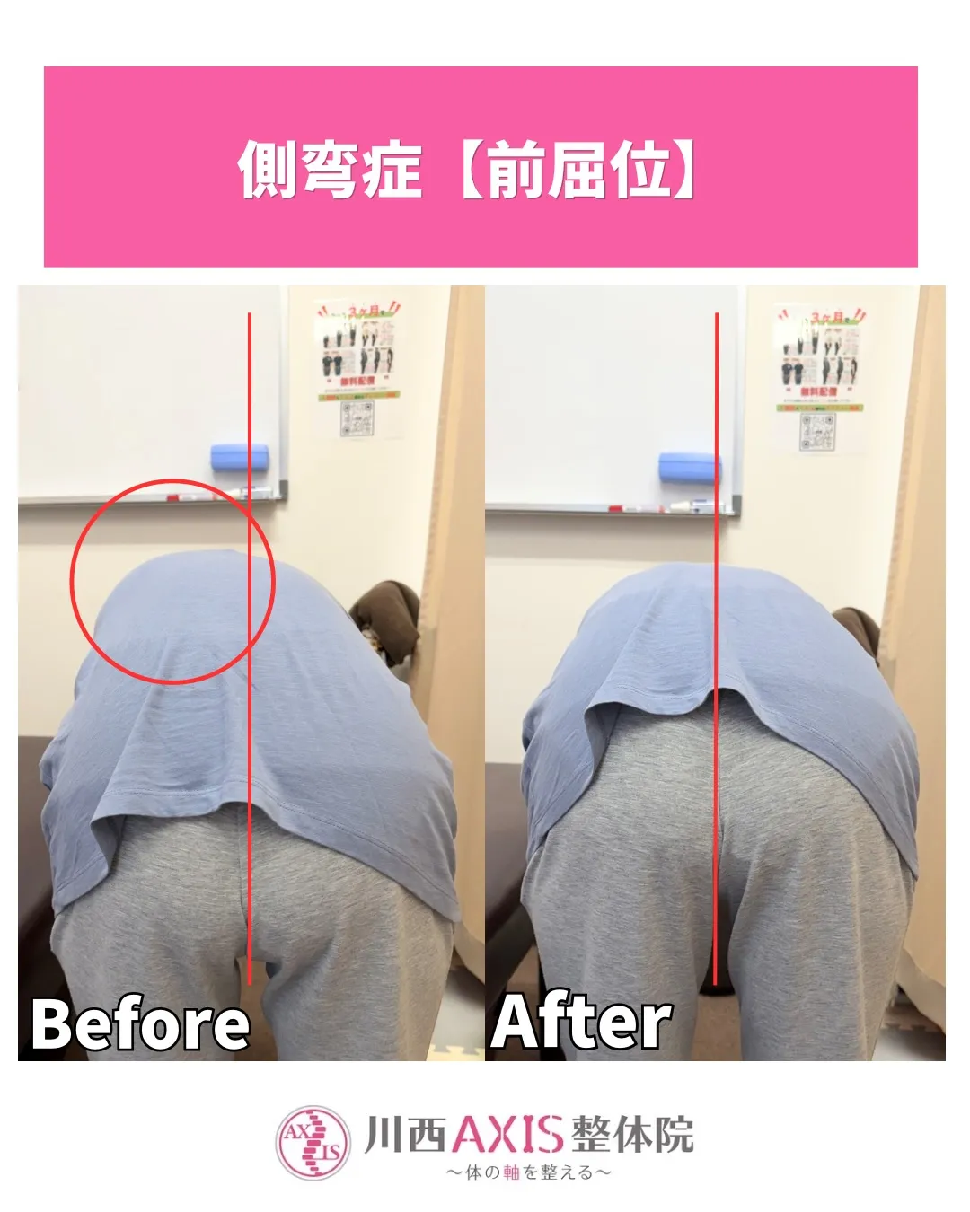 【側湾症による腰痛】川西市整体